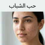 صورة غلاف واقعية لشخص عربي شاب مع حب شباب خفيف إلى متوسط ومساحة نظيفة تظهر عليها عبارة حب الشباب