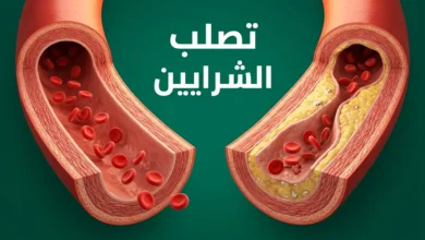 صورة غلاف توضيحية تُظهر مقطعاً عرضياً لشريان بشري، الجانب الأيمن سليم والجانب الأيسر يُظهر تراكم اللويحات الدهنية المسببة لتصلب الشرايين مع تضيّق واضح في تجويف الشريان