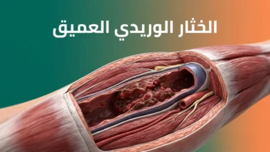 صورة توضيحية واقعية تُظهر مقطعاً تشريحياً لوريد عميق في الساق يحتوي على جلطة دموية (خثرة) تسدّ جزءاً من مجرى الدم، مع عرض الكلمة المفتاحية "الخثار الوريدي العميق" بخط عربي واضح على الغلاف