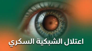 صورة مقرّبة واقعية لعين بشرية تُظهر الأوعية الدموية الدقيقة في الشبكية مع علامات مبكرة لاعتلال الشبكية السكري، مكتوب عليها اعتلال الشبكية السكري