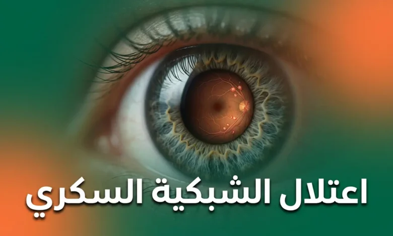 صورة مقرّبة واقعية لعين بشرية تُظهر الأوعية الدموية الدقيقة في الشبكية مع علامات مبكرة لاعتلال الشبكية السكري، مكتوب عليها اعتلال الشبكية السكري