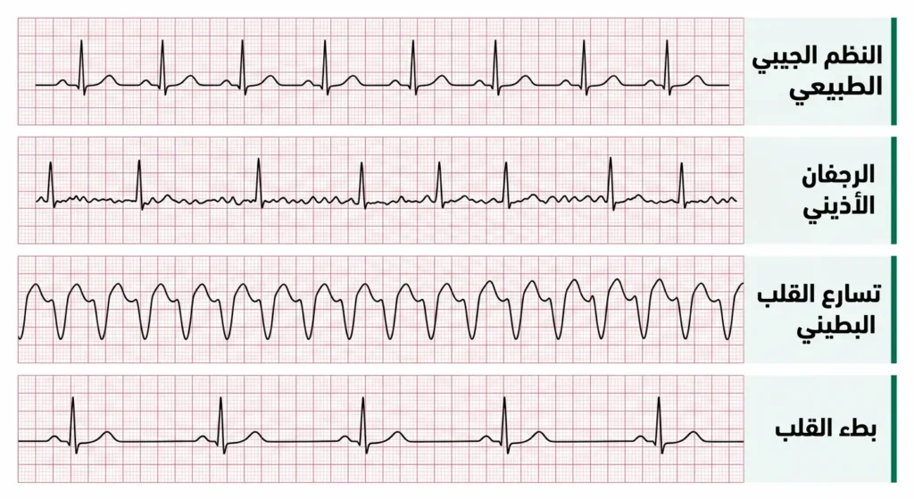 مقارنة بين أربعة تخطيطات قلب كهربائية توضح الفرق بين النظم الطبيعي والرجفان الأذيني وتسارع القلب البطيني وبطء القلب