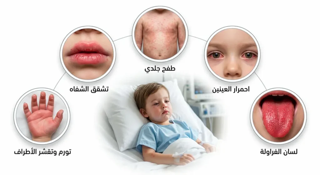 رسم توضيحي طبي واقعي يعرض المعايير التشخيصية الخمسة الرئيسية لمرض كاواساكي عند الأطفال تشمل لسان الفراولة واحمرار العينين والطفح الجلدي وتشقق الشفاه وتورم وتقشر الأطراف