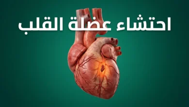 صورة توضيحية واقعية لاحتشاء عضلة القلب تُظهر قلباً بشرياً مع شريان تاجي مسدود بخثرة دموية والمنطقة المتضررة من نقص التروية