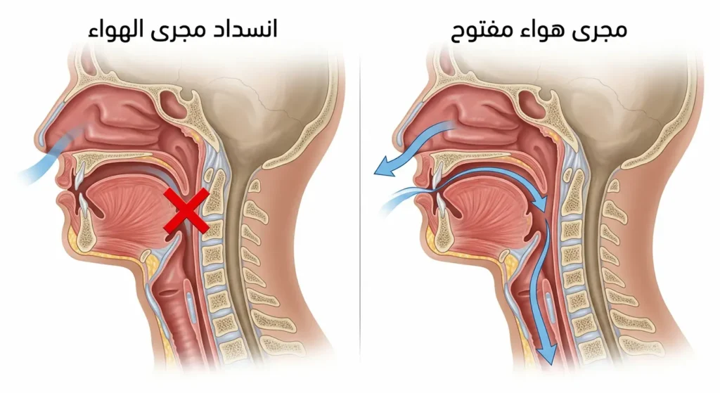 رسم توضيحي يقارن بين مجرى الهواء المفتوح أثناء التنفس الطبيعي والانسداد الذي يحدث في حالة انقطاع النفس النومي.