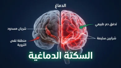 صورة توضيحية لدماغ بشري يظهر نصفه سليماً بتدفق دم طبيعي ونصفه الآخر مصاباً بانسداد شرياني يسبب السكتة الدماغية