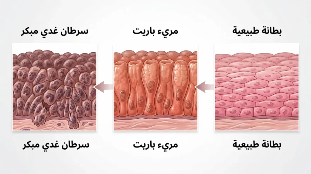 تسلسل بصري يُظهر تحوّل بطانة المريء الطبيعية إلى مريء باريت ثم إلى سرطان غدي مبكر