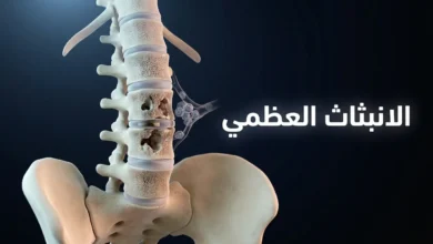 صورة غلاف ثلاثية الأبعاد واقعية تُظهر العمود الفقري والحوض مع آفات انبثاث عظمي حالة في الفقرات القطنية وخلايا سرطانية تنتقل عبر الأوعية الدموية
