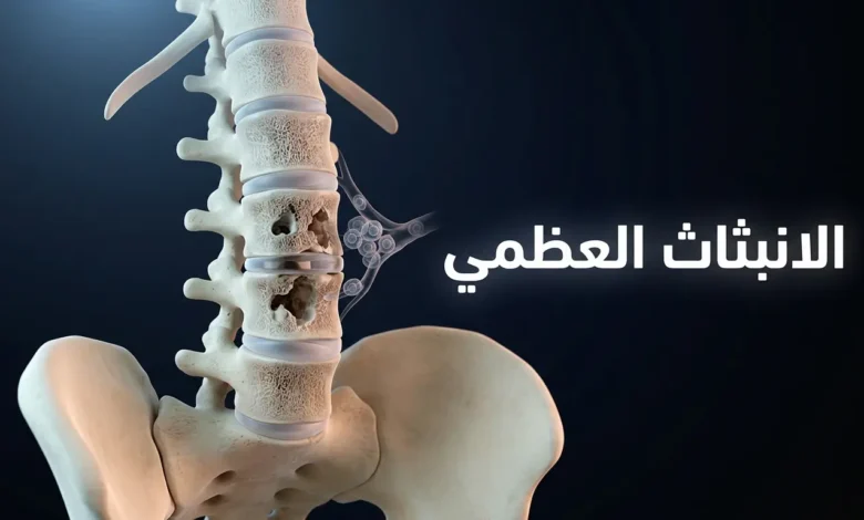 صورة غلاف ثلاثية الأبعاد واقعية تُظهر العمود الفقري والحوض مع آفات انبثاث عظمي حالة في الفقرات القطنية وخلايا سرطانية تنتقل عبر الأوعية الدموية
