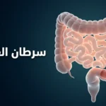 صورة غلاف توضيحية ثلاثية الأبعاد واقعية للقولون البشري تُظهر سليلة صغيرة على الجدار الداخلي مع عنوان سرطان القولون