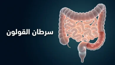 صورة غلاف توضيحية ثلاثية الأبعاد واقعية للقولون البشري تُظهر سليلة صغيرة على الجدار الداخلي مع عنوان سرطان القولون