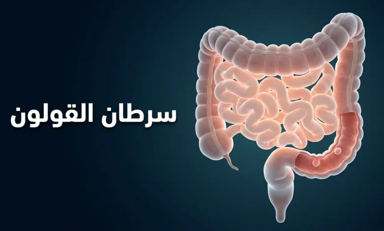 صورة غلاف توضيحية ثلاثية الأبعاد واقعية للقولون البشري تُظهر سليلة صغيرة على الجدار الداخلي مع عنوان سرطان القولون