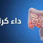 صورة غلاف توضيحية لمقال طبي عن داء كرون تظهر فيها الأمعاء مع منطقة التهاب في اللفائفي الطرفي وعنوان داء كرون باللغة العربية.