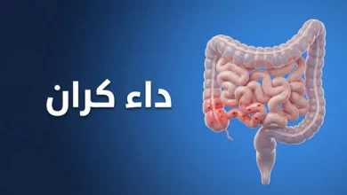 صورة غلاف توضيحية لمقال طبي عن داء كرون تظهر فيها الأمعاء مع منطقة التهاب في اللفائفي الطرفي وعنوان داء كرون باللغة العربية.