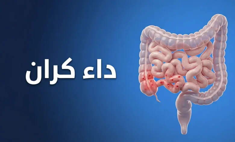 صورة غلاف توضيحية لمقال طبي عن داء كرون تظهر فيها الأمعاء مع منطقة التهاب في اللفائفي الطرفي وعنوان داء كرون باللغة العربية.