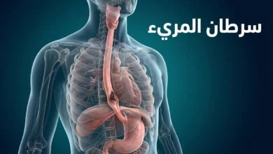 صورة غلاف توضيحية لمقال عن سرطان المريء تُظهر الجزء العلوي من الجسم مع تسليط الضوء على المريء ومنطقة الورم