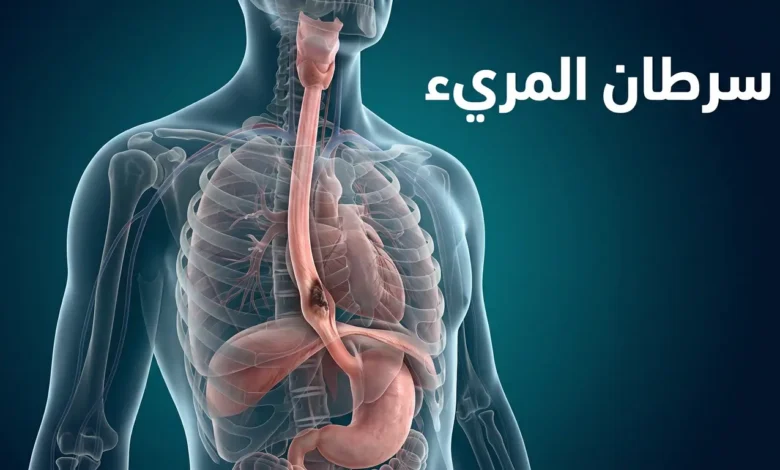 صورة غلاف توضيحية لمقال عن سرطان المريء تُظهر الجزء العلوي من الجسم مع تسليط الضوء على المريء ومنطقة الورم