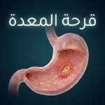 صورة غلاف ثلاثية الأبعاد واقعية تُظهر معدة بشرية شفافة مع قرحة واضحة في البطانة المخاطية وعنوان قرحة المعدة