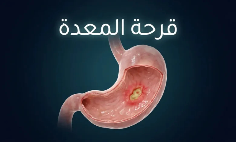 صورة غلاف ثلاثية الأبعاد واقعية تُظهر معدة بشرية شفافة مع قرحة واضحة في البطانة المخاطية وعنوان قرحة المعدة