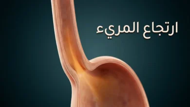 صورة غلاف توضيحية لمقال ارتجاع المريء تُظهر مقطعاً تشريحياً ثلاثي الأبعاد للمريء والمعدة مع تمثيل بصري لصعود الحمض
