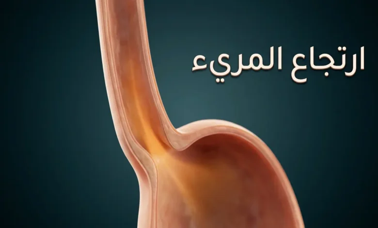 صورة غلاف توضيحية لمقال ارتجاع المريء تُظهر مقطعاً تشريحياً ثلاثي الأبعاد للمريء والمعدة مع تمثيل بصري لصعود الحمض