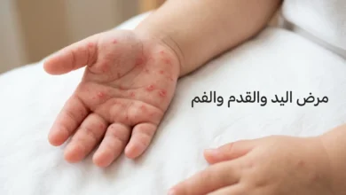 يدا طفل صغير تُظهران بثوراً حمراء بيضاوية مميزة لمرض اليد والقدم والفم