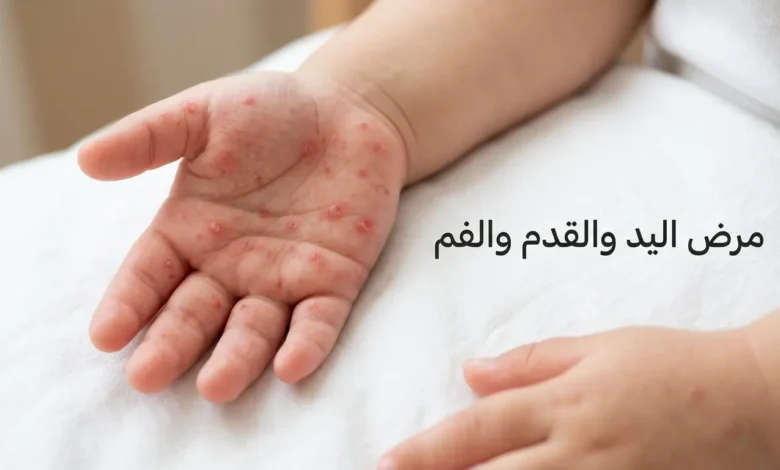 يدا طفل صغير تُظهران بثوراً حمراء بيضاوية مميزة لمرض اليد والقدم والفم