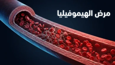 صورة غلاف توضيحية ثلاثية الأبعاد تُظهر مقطعاً عرضياً لوعاء دموي مع خثرة غير مكتملة تمثل مرض الهيموفيليا