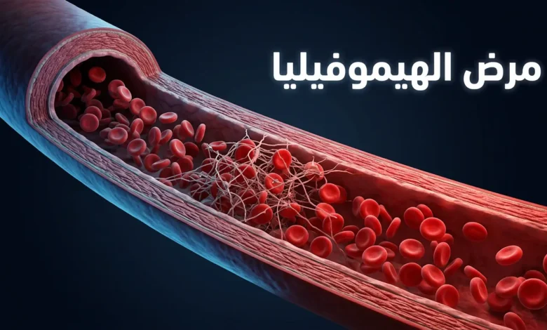 صورة غلاف توضيحية ثلاثية الأبعاد تُظهر مقطعاً عرضياً لوعاء دموي مع خثرة غير مكتملة تمثل مرض الهيموفيليا