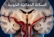 رسم طبي ثلاثي الأبعاد يُظهر الشريان القاعدي الطبيعي مقابل الشريان القاعدي المتوسِّع في الدماغ البشري