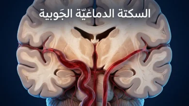 رسم طبي ثلاثي الأبعاد يُظهر الشريان القاعدي الطبيعي مقابل الشريان القاعدي المتوسِّع في الدماغ البشري