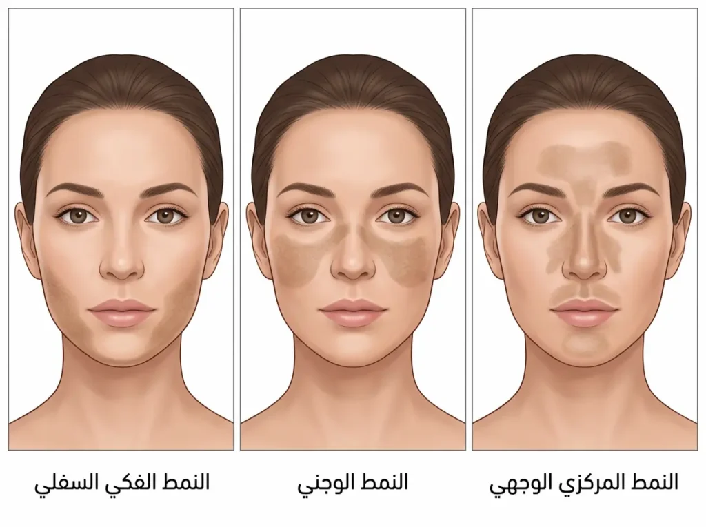 رسم طبي يوضح أنماط توزع الكلف على الوجه: المركزي الوجهي والوجني والفكي السفلي.