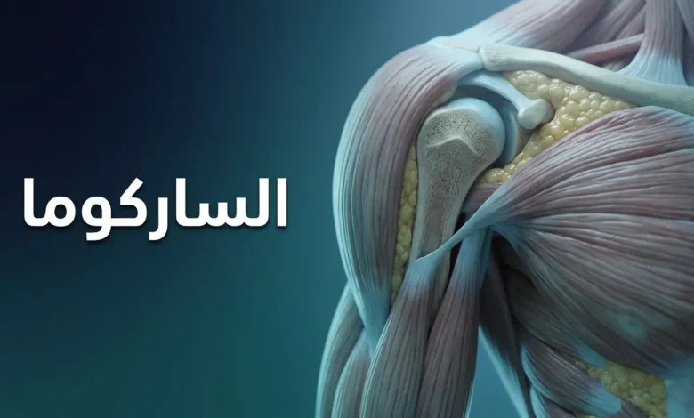صورة غلاف مقال الساركوما تُظهر الأنسجة الضامة البشرية من عظام وعضلات ودهون مع كلمة الساركوما بالعربية.