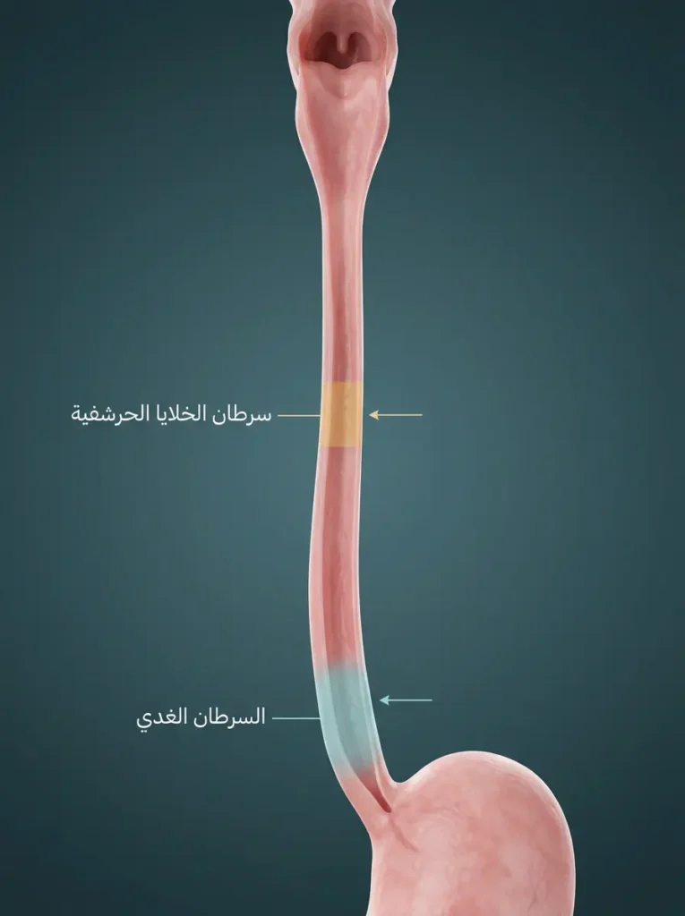 رسم ثلاثي الأبعاد للمريء يُقارن بين موقعي نشوء سرطان الخلايا الحرشفية في الثلث العلوي والأوسط والسرطان الغدي في الثلث السفلي
