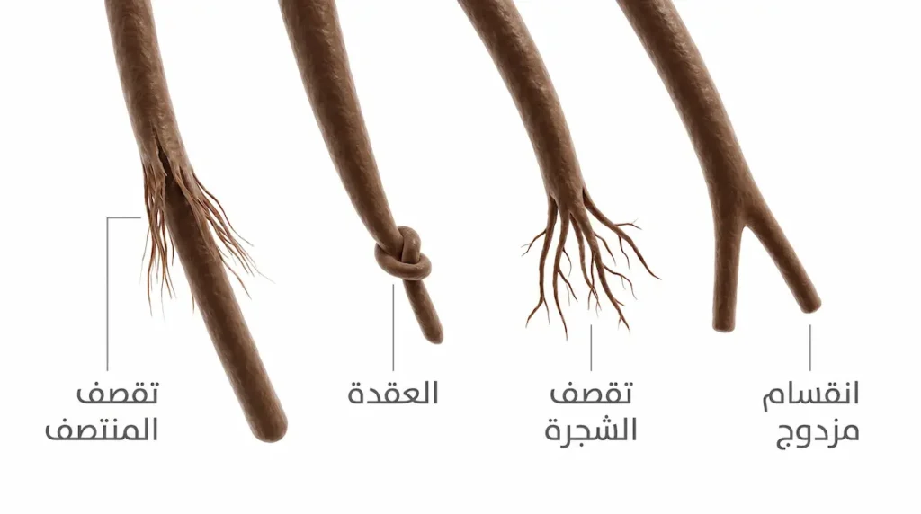 رسم توضيحي طبي يعرض أربعة أنماط لتقصف الشعر وهي الانقسام المزدوج وتقصف الشجرة والعقدة وتقصف المنتصف