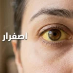 صورة مقرّبة لعين بشرية يظهر فيها اصفرار واضح في بياض العين (الصُّلبة) كعلامة على اليرقان