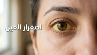 صورة مقرّبة لعين بشرية يظهر فيها اصفرار واضح في بياض العين (الصُّلبة) كعلامة على اليرقان