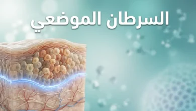 صورة غلاف طبية توضيحية تُظهر مقطعاً عرضياً ثلاثي الأبعاد لنسيج بشري مع خلايا غير طبيعية محصورة فوق الغشاء القاعدي السليم وعنوان السرطان الموضعي