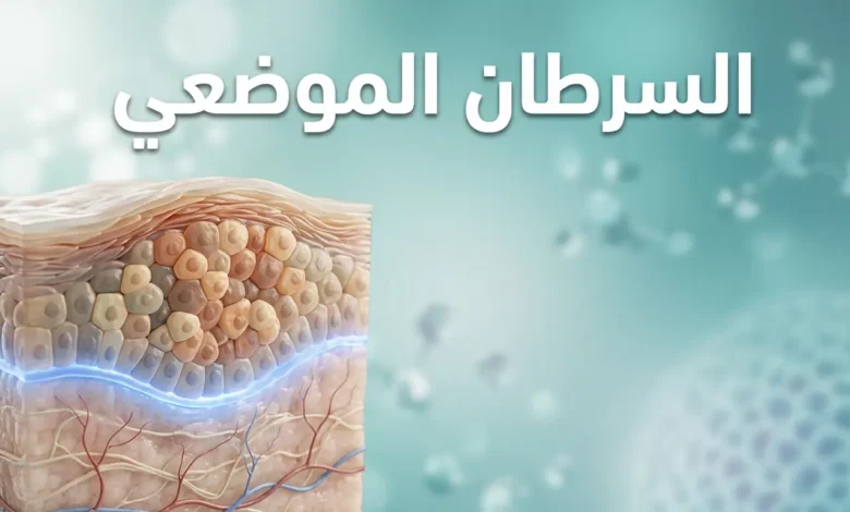 صورة غلاف طبية توضيحية تُظهر مقطعاً عرضياً ثلاثي الأبعاد لنسيج بشري مع خلايا غير طبيعية محصورة فوق الغشاء القاعدي السليم وعنوان السرطان الموضعي