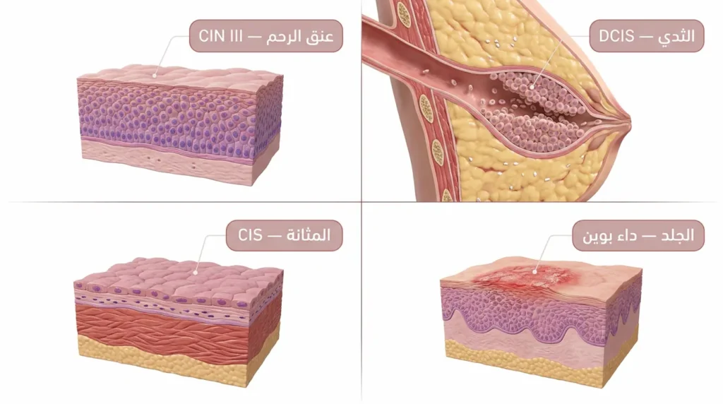 رسم طبي ثلاثي الأبعاد يعرض أربعة أشكال شائعة للسرطان الموضعي في الثدي وعنق الرحم والجلد والمثانة مع مقاطع نسيجية لكل عضو