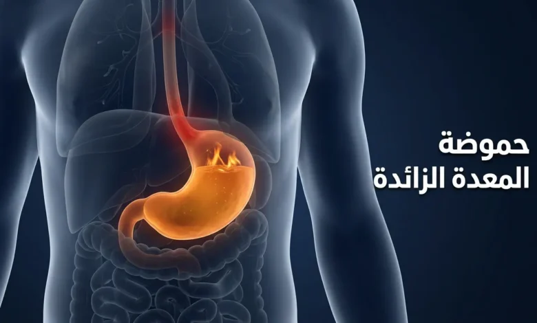 صورة غلاف توضيحية تُظهر جذعاً بشرياً شفافاً بداخله معدة متوهجة بلون كهرماني يمثل فرط حموضة المعدة مع نص عربي "حموضة المعدة الزائدة"