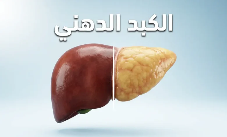 صورة ثلاثية الأبعاد واقعية تقارن بين كبد صحي بلون أحمر داكن وكبد دهني شاحب متضخم مع نص الكبد الدهني