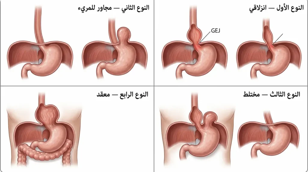 رسم طبي يوضح الأنواع الأربعة لفتق الحجاب الحاجز: الانزلاقي والمجاور للمريء والمختلط والمعقد