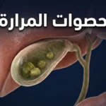 صورة غلاف ثلاثية الأبعاد واقعية تُظهر المرارة شبه الشفافة أسفل الكبد وبداخلها عدة حصوات كوليسترولية بأحجام مختلفة مع ظهور القنوات الصفراوية
