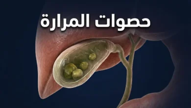 صورة غلاف ثلاثية الأبعاد واقعية تُظهر المرارة شبه الشفافة أسفل الكبد وبداخلها عدة حصوات كوليسترولية بأحجام مختلفة مع ظهور القنوات الصفراوية