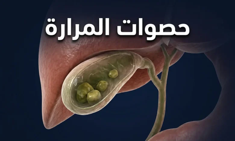 صورة غلاف ثلاثية الأبعاد واقعية تُظهر المرارة شبه الشفافة أسفل الكبد وبداخلها عدة حصوات كوليسترولية بأحجام مختلفة مع ظهور القنوات الصفراوية