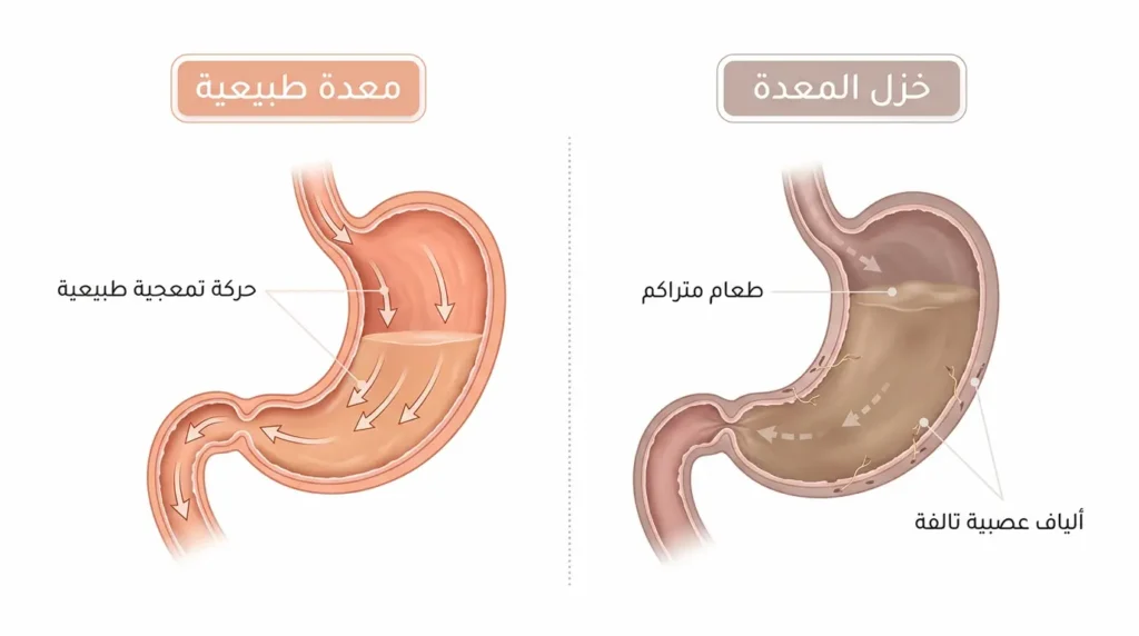 رسم طبي واقعي يقارن بين المعدة الطبيعية ذات الحركة التمعجية السليمة وخزل المعدة حيث يتراكم الطعام بسبب تلف الألياف العصبية