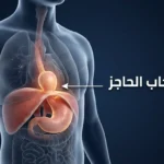 رسم ثلاثي الأبعاد واقعي يوضح فتق الحجاب الحاجز مع انزلاق الجزء العلوي من المعدة عبر الفتحة الحجابية إلى تجويف الصدر