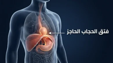 رسم ثلاثي الأبعاد واقعي يوضح فتق الحجاب الحاجز مع انزلاق الجزء العلوي من المعدة عبر الفتحة الحجابية إلى تجويف الصدر
