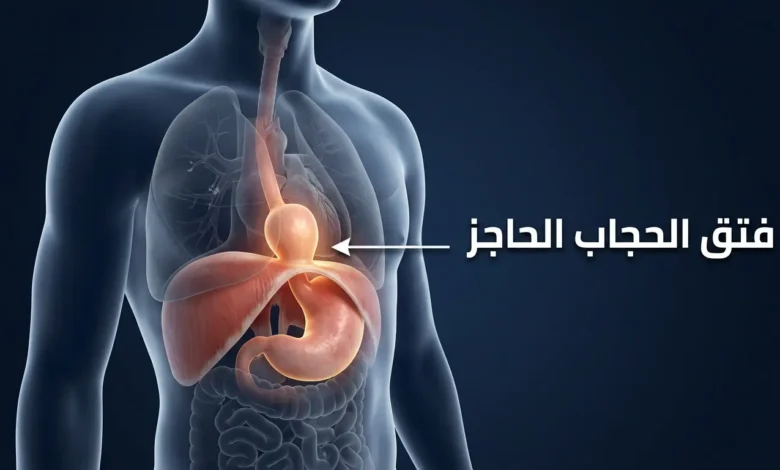 رسم ثلاثي الأبعاد واقعي يوضح فتق الحجاب الحاجز مع انزلاق الجزء العلوي من المعدة عبر الفتحة الحجابية إلى تجويف الصدر